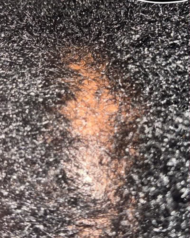 Before — Trichoscope imaging: density and follicle recovery