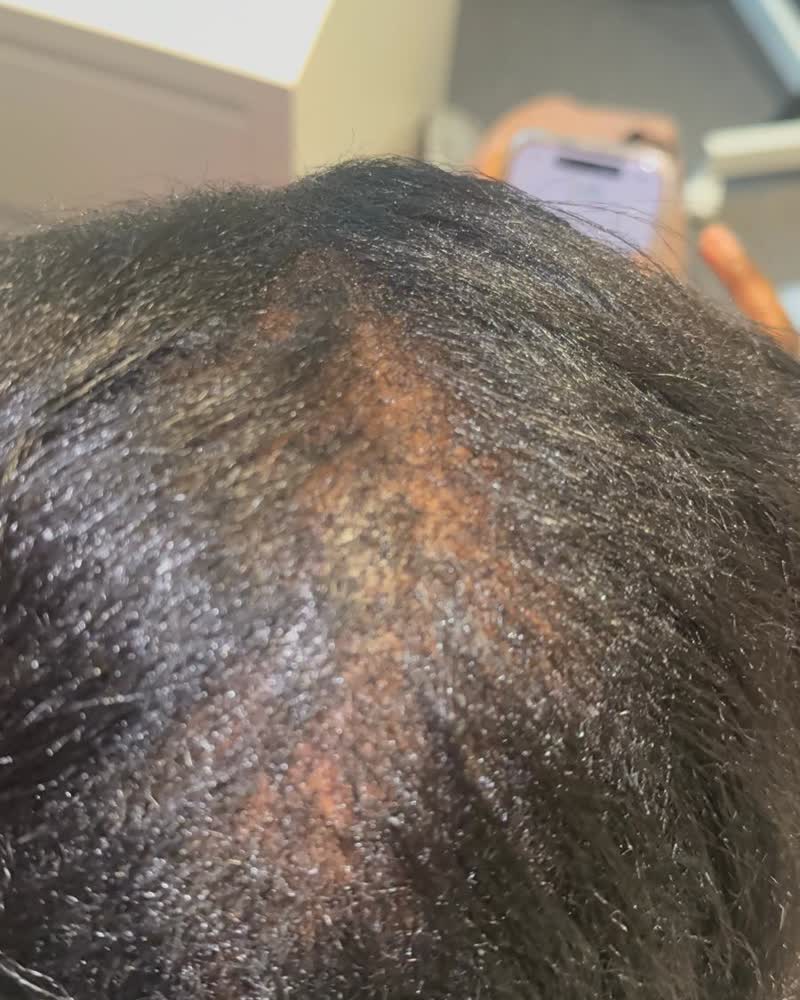 Before — Widening part line restored along the scalp
