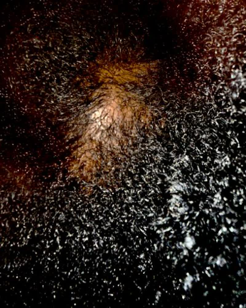 After — Trichoscope imaging: density and follicle recovery