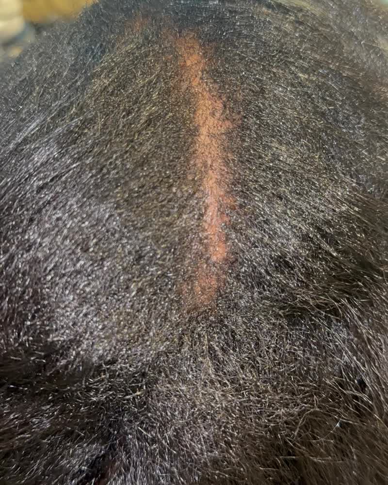After — Widening part line restored along the scalp